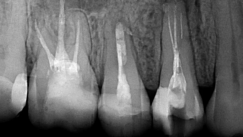 Röntgenbild Feilenfragment