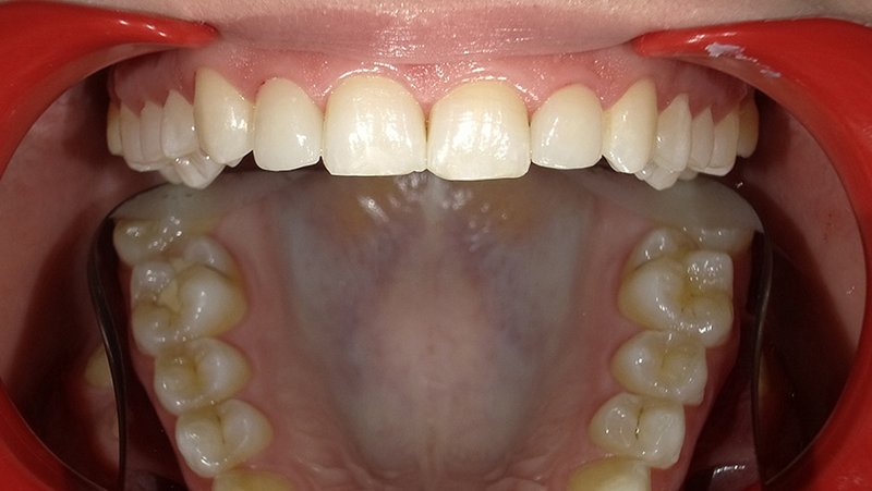 Fallberichtbild: Ergebnis geöffnet, beide Kiefer bei offenem Mund