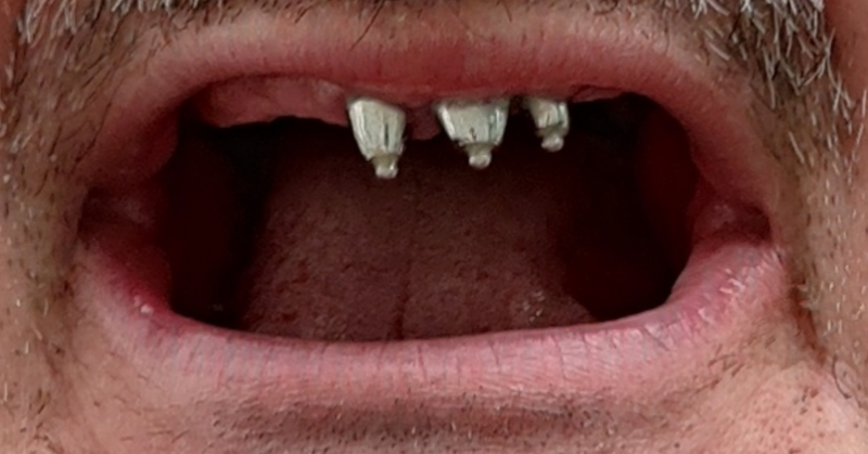 Kronen mit Lokatorenspitze