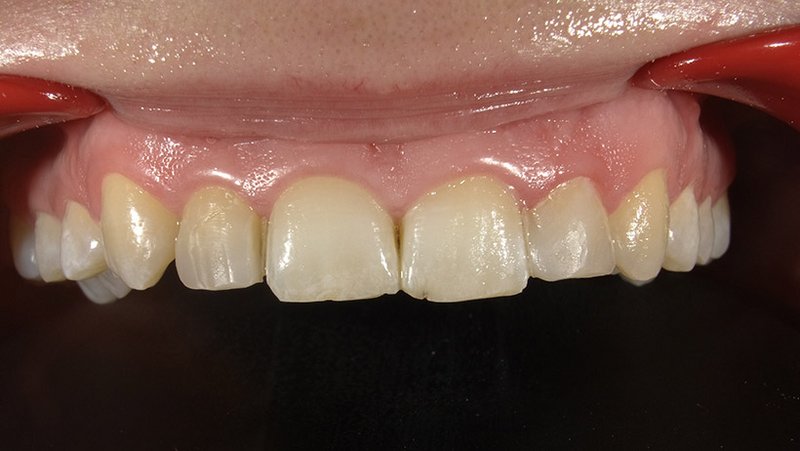 Fallberichtbild Ausgangslage vor Behandlung: Oberkiefer