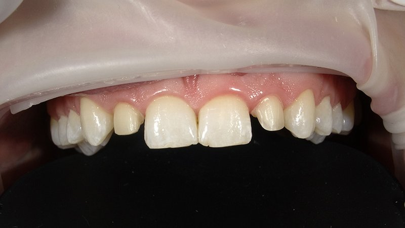 Fallberichtbild: Ausgangslage Oberkiefer