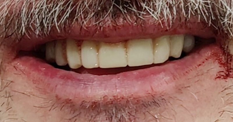 Bissrehabilitation Provisorium