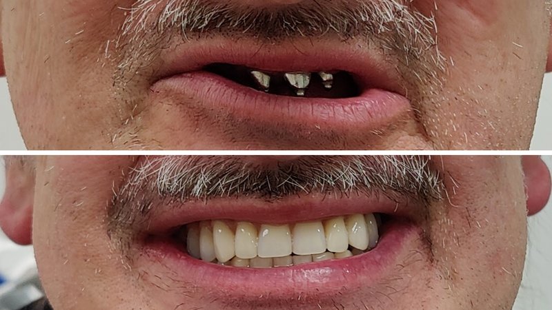 Lächeln vorher und nachher