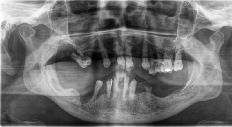 OPG nach Entfernung von Zahnstein, Gingivahyperplasien und Prothesen