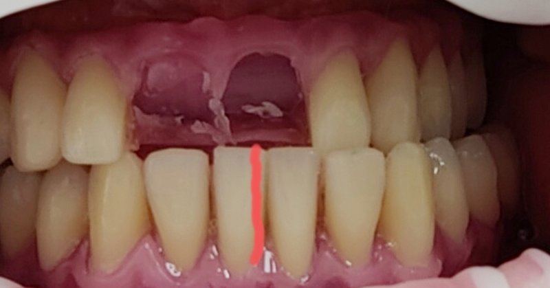 Bissrehabilitation Wachsaufstellung