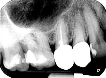 Röntgen Krone insuffizient