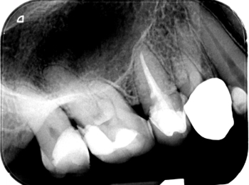 Röntgen Langzeitprovisorium