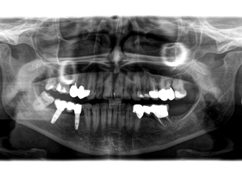 Röntgen OPG Erstbefund