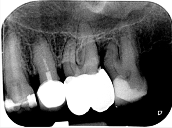 Röntgen Krone distal