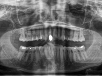 Röntgen Frontzahnimplantat OPG nach Unfall