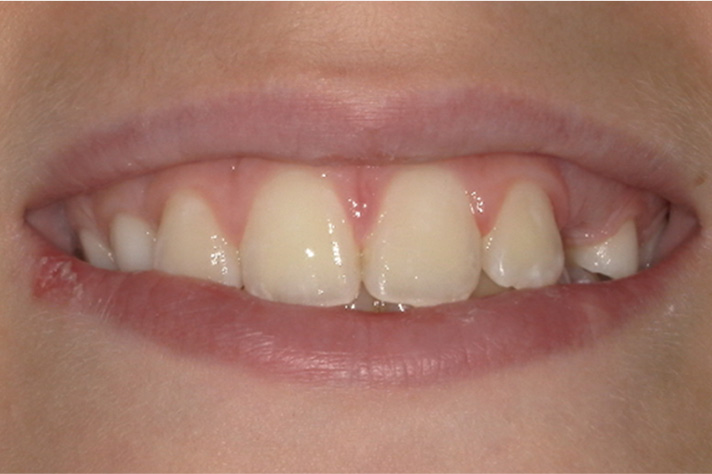 Fallberichtbild: Lächeln des Patienten nach Behandlung 