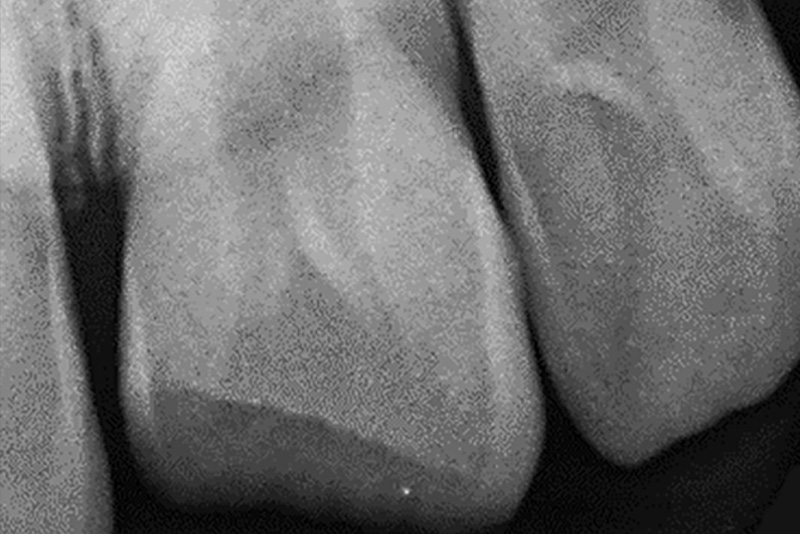 Fallberichtbild Rönten 