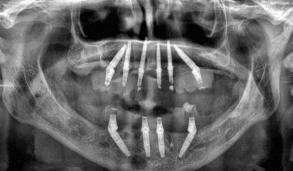Fallberichtsbild Implantologie Röntgenaufnahme