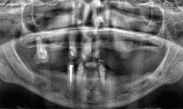 Fallberichtsbild Implantologie Röntgenaufnahme